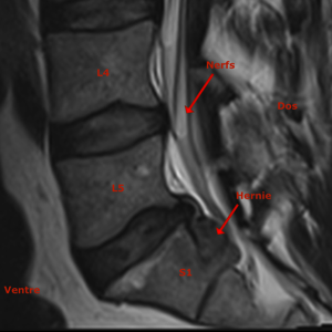 Hernie discale lombaire – CFDOS