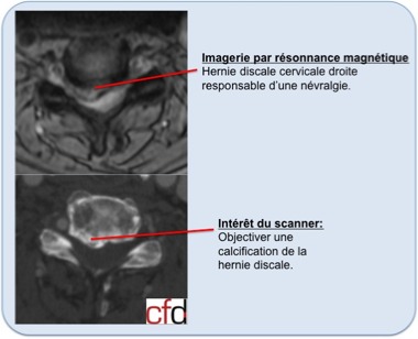 Hernie discale cervicale – CFDOS