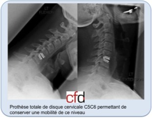 Hernie discale cervicale – CFDOS