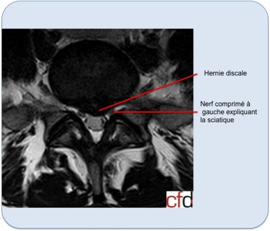 Hernie discale lombaire – CFDOS