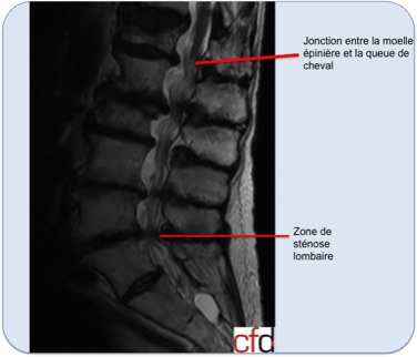 Sténose lombaire – CFDOS