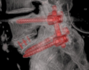 Arthrodèse lombaire – CFDOS